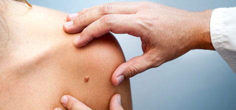 GP checking patient's mole